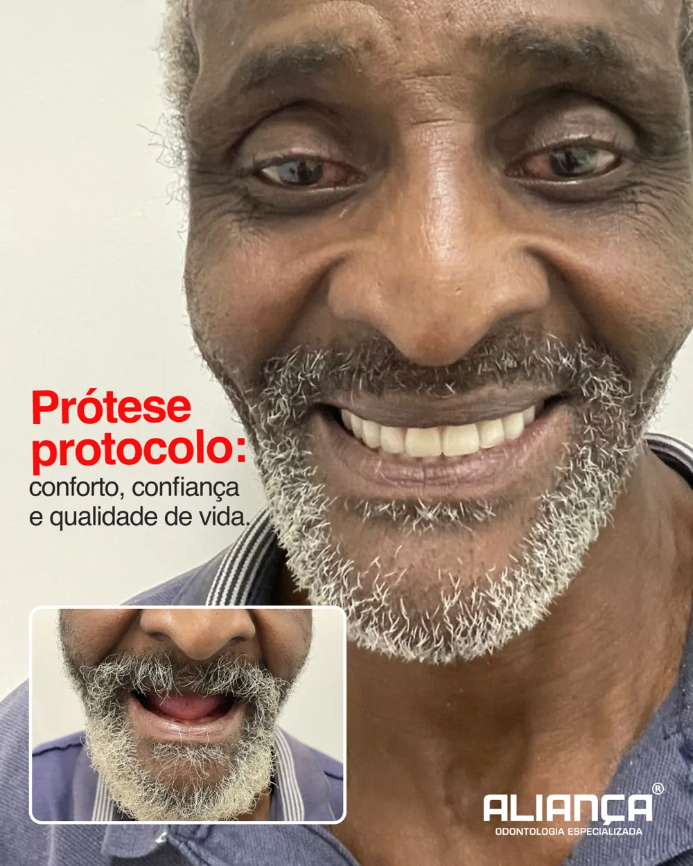 Caso real de prótese protocolo — antes e depois — Aliança Odontologia