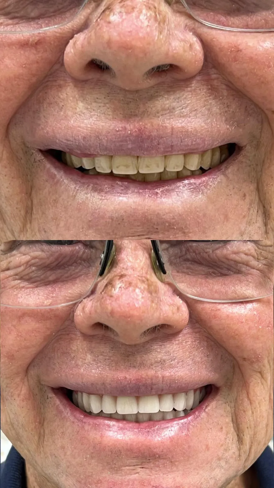 Prótese protocolo — antes e depois